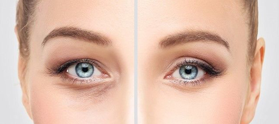 Two Reasons for Avoiding Tear Through Fillers