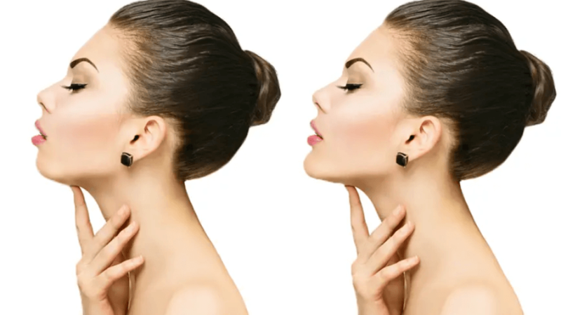 Jawline / Çene Hattı Şekillendirme Nedir? Artıları ve Eksileri