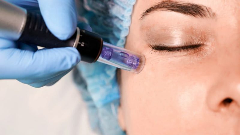 Dermapen Nedir? Altın İğneden Farkı