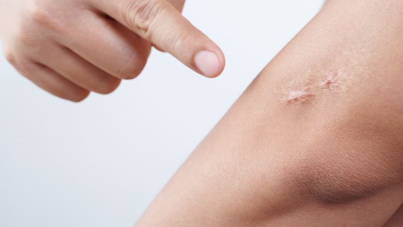 Keloid Nedir? Neden Olur, Nasıl Geçer?